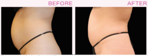 Read more about the article Emsculpt: The Non-Surgical Way to Sculpt Your Body